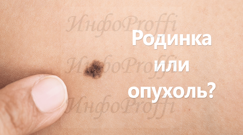 21 мая 2018 года жители Дона могут пройти бесплатное обследование на наличие меланомы - image CHto-takoe-melanoma-i-kak-ona-vyglyadit-7-800x445 on http://infoproffi.ru