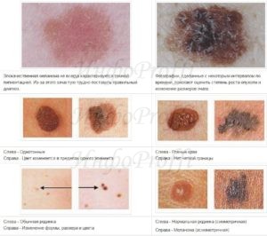 21 мая 2018 года жители Дона могут пройти бесплатное обследование на наличие меланомы - image melanoma_foto-300x266 on http://infoproffi.ru